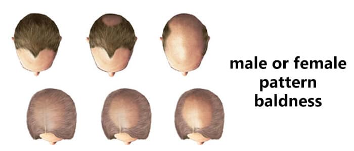 Hair Loss Causes and Solutions