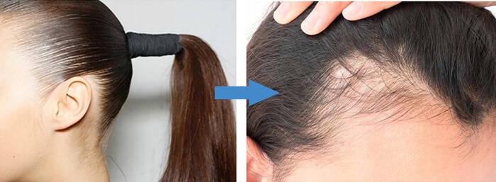 Hair Loss Causes and Solutions