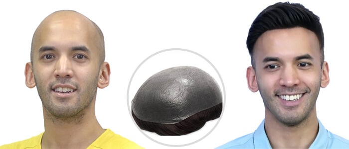 Hair Loss Causes and Solutions