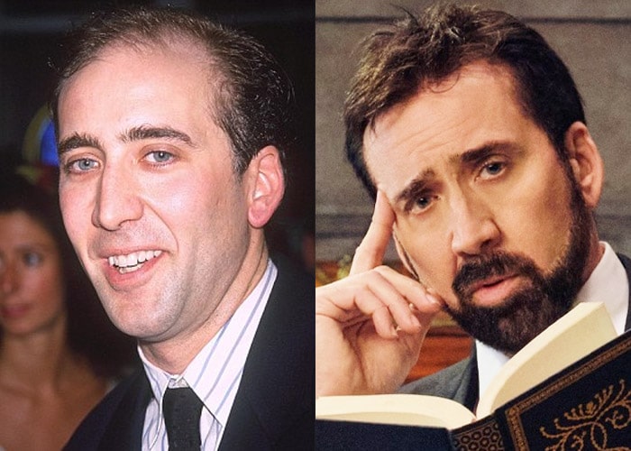 Nicolas-Cage-hair-loss