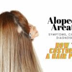 Alopecia-Areata