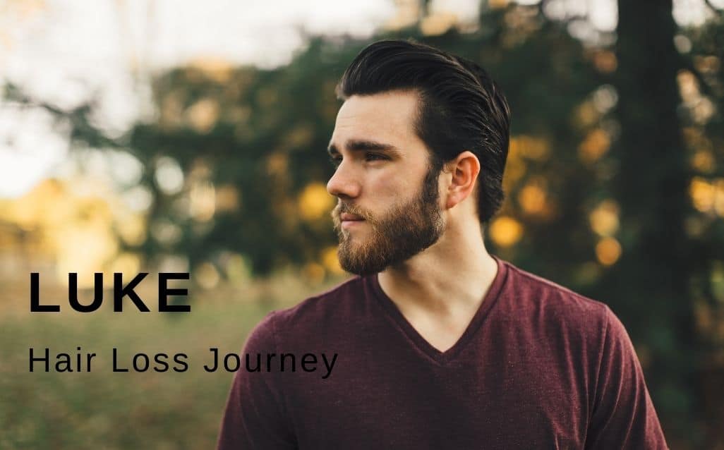 luke-Hair-Loss-Journey