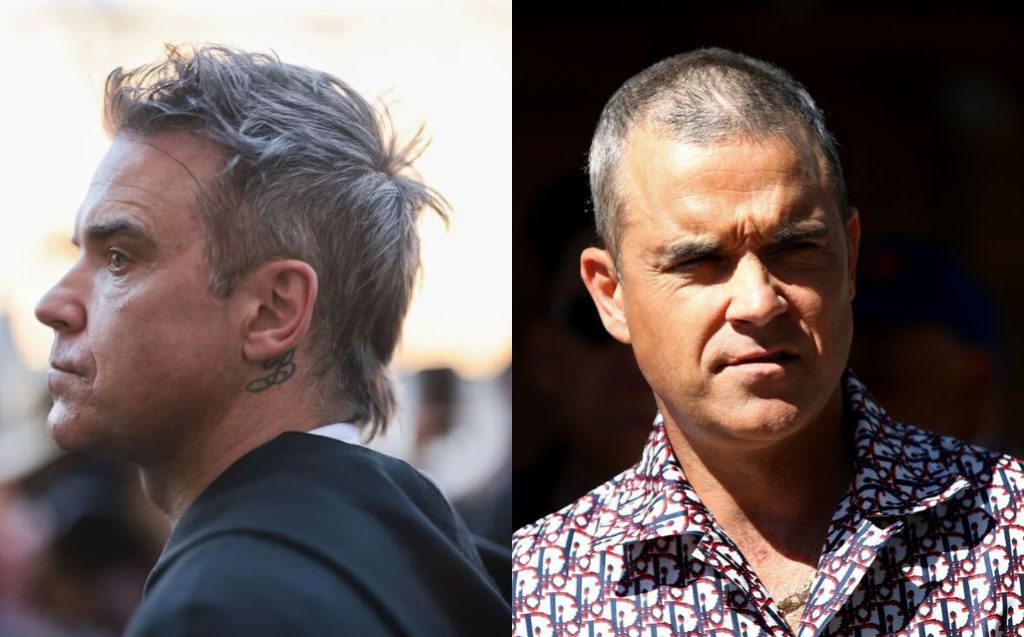 Robbie-Williams-hair-transplant-failed